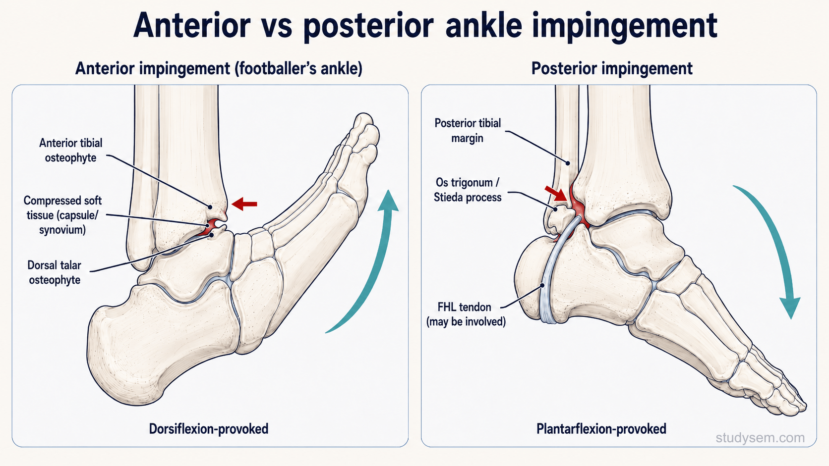 Two-panel comparative diagram showing anterior ankle impingement with tibial and talar osteophytes compressed during dorsiflexion on the left and posterior impingement with os trigonum compressed during plantarflexion on the right