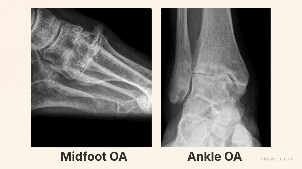 AI-generated X-ray images showing midfoot osteoarthritis with tarsometatarsal joint space narrowing and dorsal osteophytes alongside ankle osteoarthritis with tibiotalar joint space narrowing