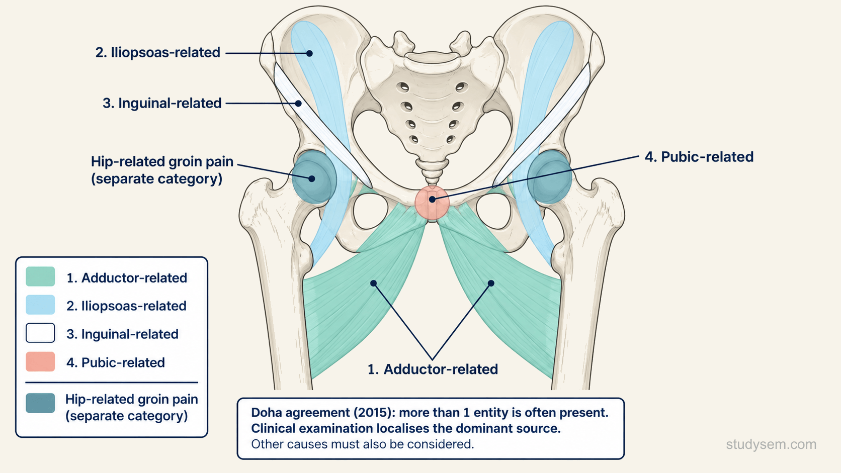 Front view of the pelvis and upper thighs colour coding the Doha classification of groin pain in athletes: 1, adductor-related, over the adductors from the pubis down the inner thighs; 2, iliopsoas-related, along the iliopsoas from the iliac fossa towards the lesser trochanter; 3, inguinal-related, along the inguinal canal; 4, pubic-related, over the pubic symphysis; and, as a separate category, hip-related groin pain over each hip joint. A footer reads: Doha agreement (2015): more than 1 entity is often present. Clinical examination localises the dominant source. Other causes must also be considered.
