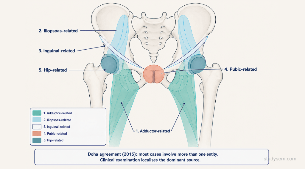 Anterior pelvis diagram showing the Doha agreement five clinical entities of athletic groin pain: adductor-related, iliopsoas-related, inguinal-related, pubic-related, and hip-related regions