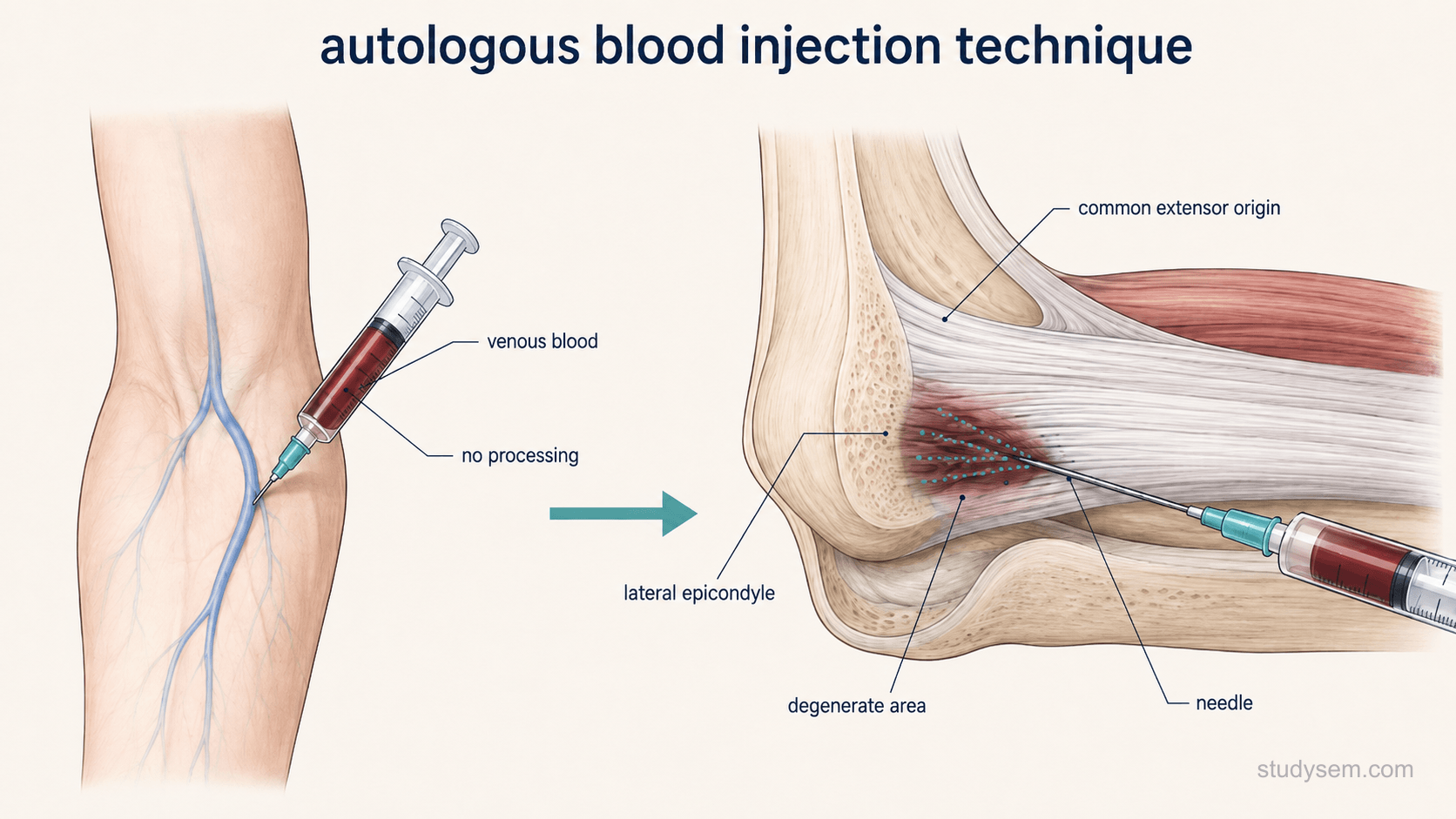 Two-stage illustration on a cream background. On the left, venous blood is drawn from an anatomically accurate antecubital fossa into a plain syringe, with a short arrow indicating that the blood is not centrifuged or processed. On the right, an anatomically accurate longitudinal section of the common extensor origin at the lateral epicondyle shows a needle delivering the unspun blood into a darker degenerate area at the enthesis, with a few fine dotted lines indicating optional fenestration passes through the lesion. Labels only: venous blood, no processing, common extensor origin, lateral epicondyle, symptomatic area, needle, optional fenestration.