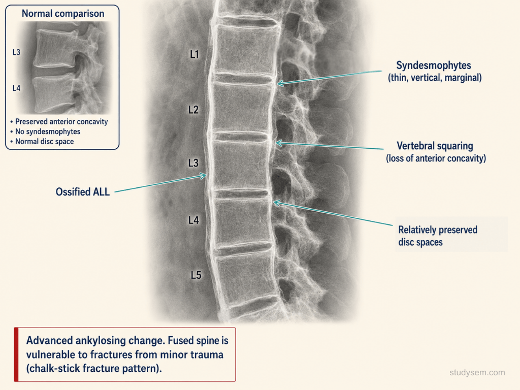 Lateral lumbar spine radiograph in advanced ankylosing spondylitis showing flowing marginal syndesmophytes bridging contiguous vertebral bodies, producing the bamboo spine appearance with squared vertebrae