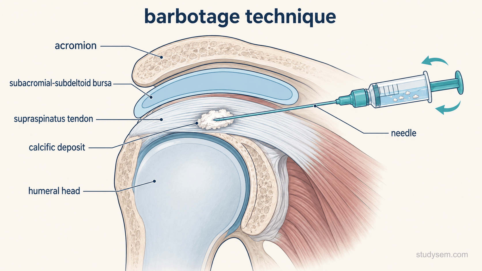 Anatomically accurate coronal section of the shoulder showing the humeral head, greater tuberosity, acromion, subacromial-subdeltoid bursa and the supraspinatus tendon, with a bright calcific deposit within the tendon. A needle passes in-plane through the skin and bursa into the deposit. Two small curved arrows at the needle hub indicate saline being injected and withdrawn, with a few pale flecks of calcium suspended in the returning fluid. Labels only: acromion, subacromial-subdeltoid bursa, supraspinatus tendon, calcific deposit, humeral head, needle.