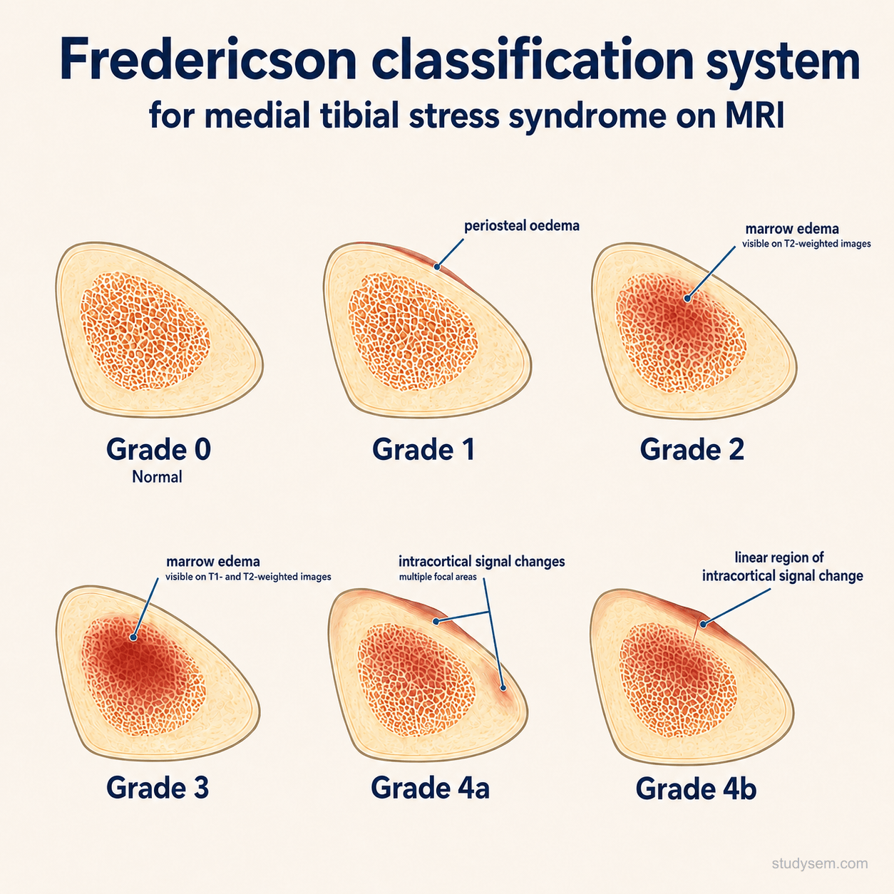 Five-panel tibial MRI series demonstrating the Fredericson grading system: grade 1 (periosteal oedema only on T2/STIR), grade 2 (bone marrow oedema on T2 with periosteal oedema), grade 3 (marrow oedema on T1 and T2), grade 4a (intracortical signal change without a visible fracture line), and grade 4b (visible fracture line within oedematous bone). MRI is the gold standard investigation.