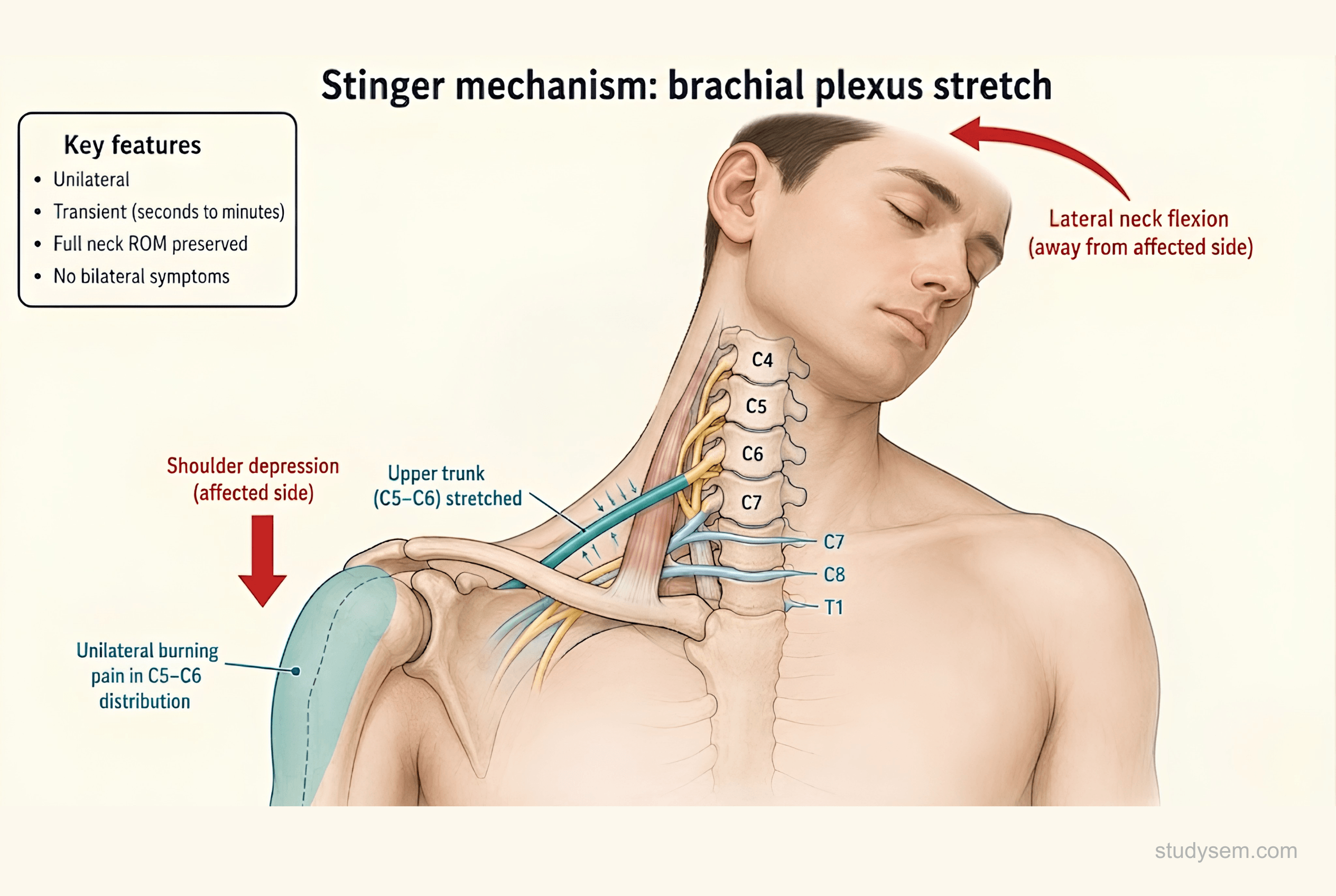 Stinger mechanism showing lateral neck flexion and shoulder depression stretching the upper trunk C5-C6 of the brachial plexus producing unilateral transient burning pain