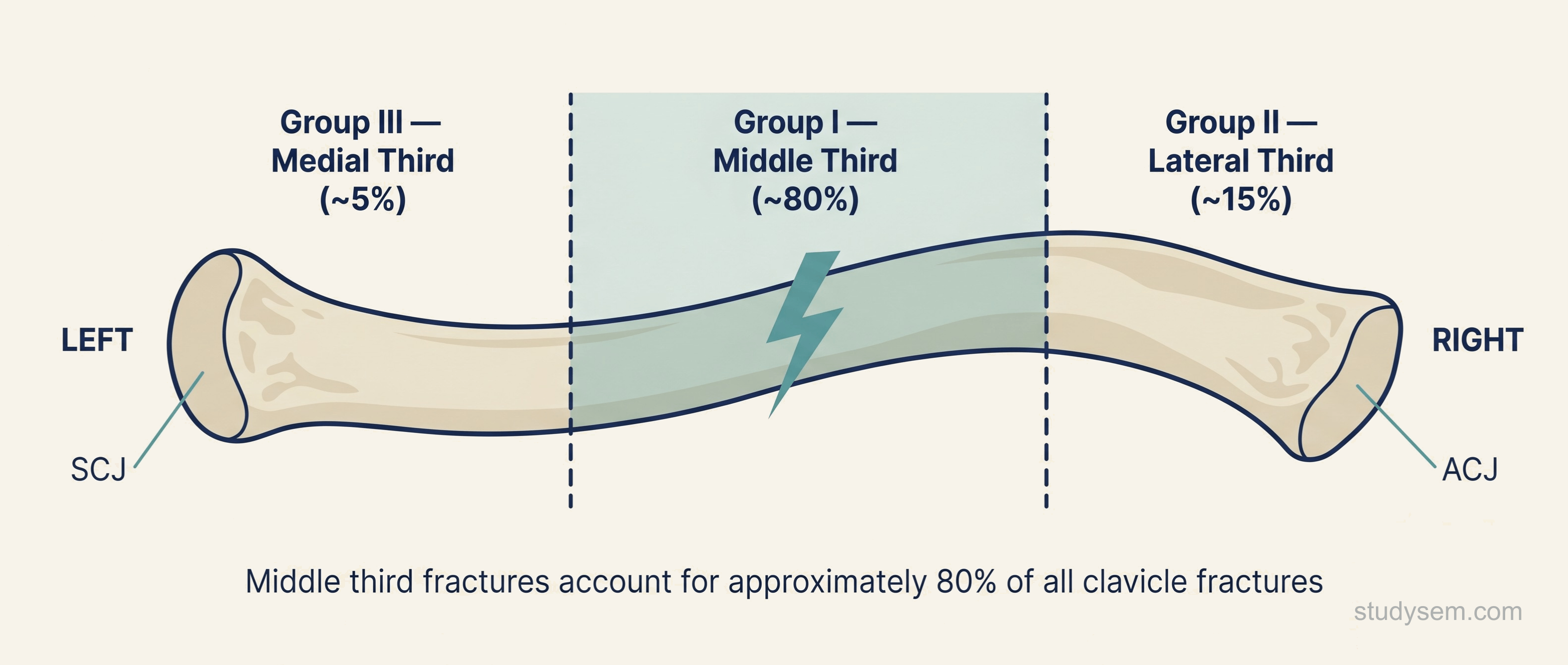 Allman classification of clavicle fractures showing Group I middle third, Group II lateral third, and Group III medial third.