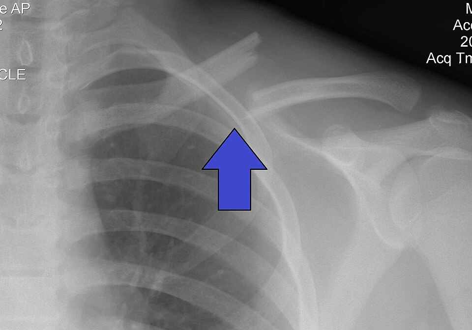 AP radiograph of a displaced midshaft clavicle fracture in an adult.