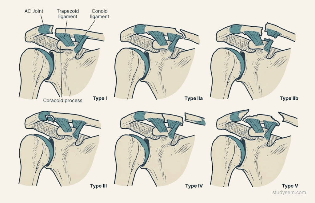 Diagram of the Neer classification for lateral clavicle fractures showing all five types.