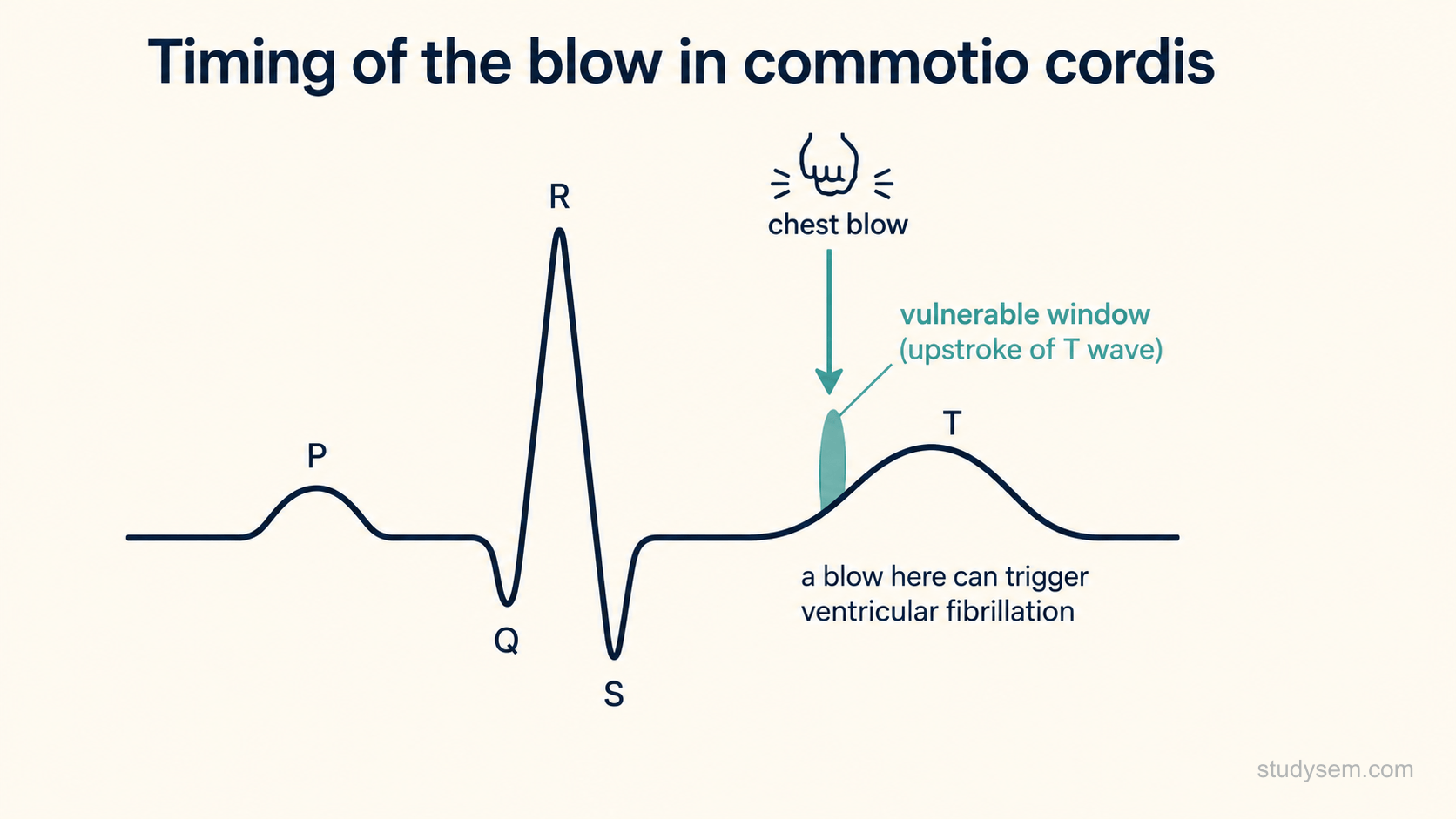 Stylised single electrocardiogram complex labelled P, Q, R, S and T, with a narrow vulnerable window shaded on the upstroke of the T wave and an arrow showing that a chest blow must coincide with this brief window to trigger ventricular fibrillation.