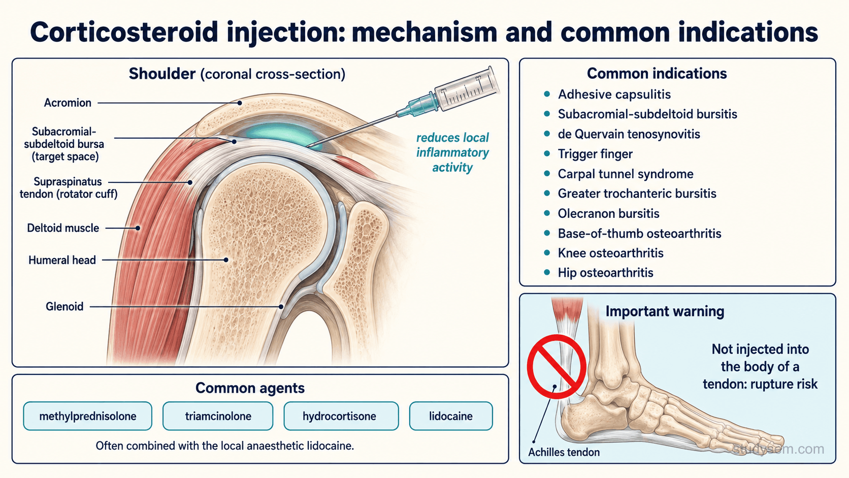 An educational figure titled 'Corticosteroid injection: mechanism and common indications'. On the left, an anatomically accurate shoulder in cross-section shows a needle entering the subacromial space beneath the acromion and above the supraspinatus tendon, with the deltoid, acromion, subacromial-subdeltoid bursa and rotator cuff tendon labelled, illustrating suppression of local inflammation in the bursa. A note lists common named agents: methylprednisolone, triamcinolone and hydrocortisone, often combined with the local anaesthetic lidocaine. On the right, a list of common indications: adhesive capsulitis, subacromial-subdeltoid bursitis, de Quervain tenosynovitis, trigger finger, carpal tunnel syndrome, greater trochanteric and olecranon bursitis, base-of-thumb osteoarthritis, and knee and hip osteoarthritis. A prominent warning panel shows an anatomically correct Achilles tendon with a no-entry symbol over the tendon body and the caption 'not injected into the body of a tendon: rupture risk'.
