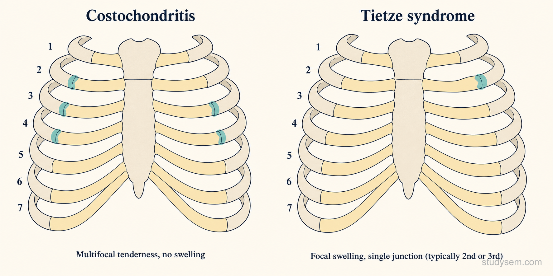 Anterior chest wall comparison showing costochondritis with multiple costochondral junctions affected without swelling, versus Tietze syndrome with focal swelling at a single costochondral junction.