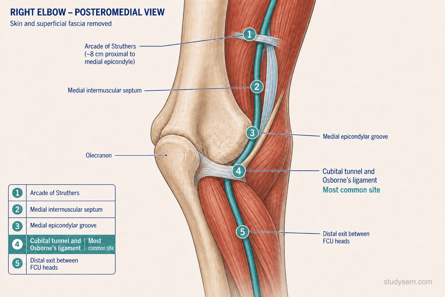 Posteromedial elbow anatomy showing five potential ulnar nerve compression sites from arcade of Struthers to FCU heads with the cubital tunnel highlighted as the most common.