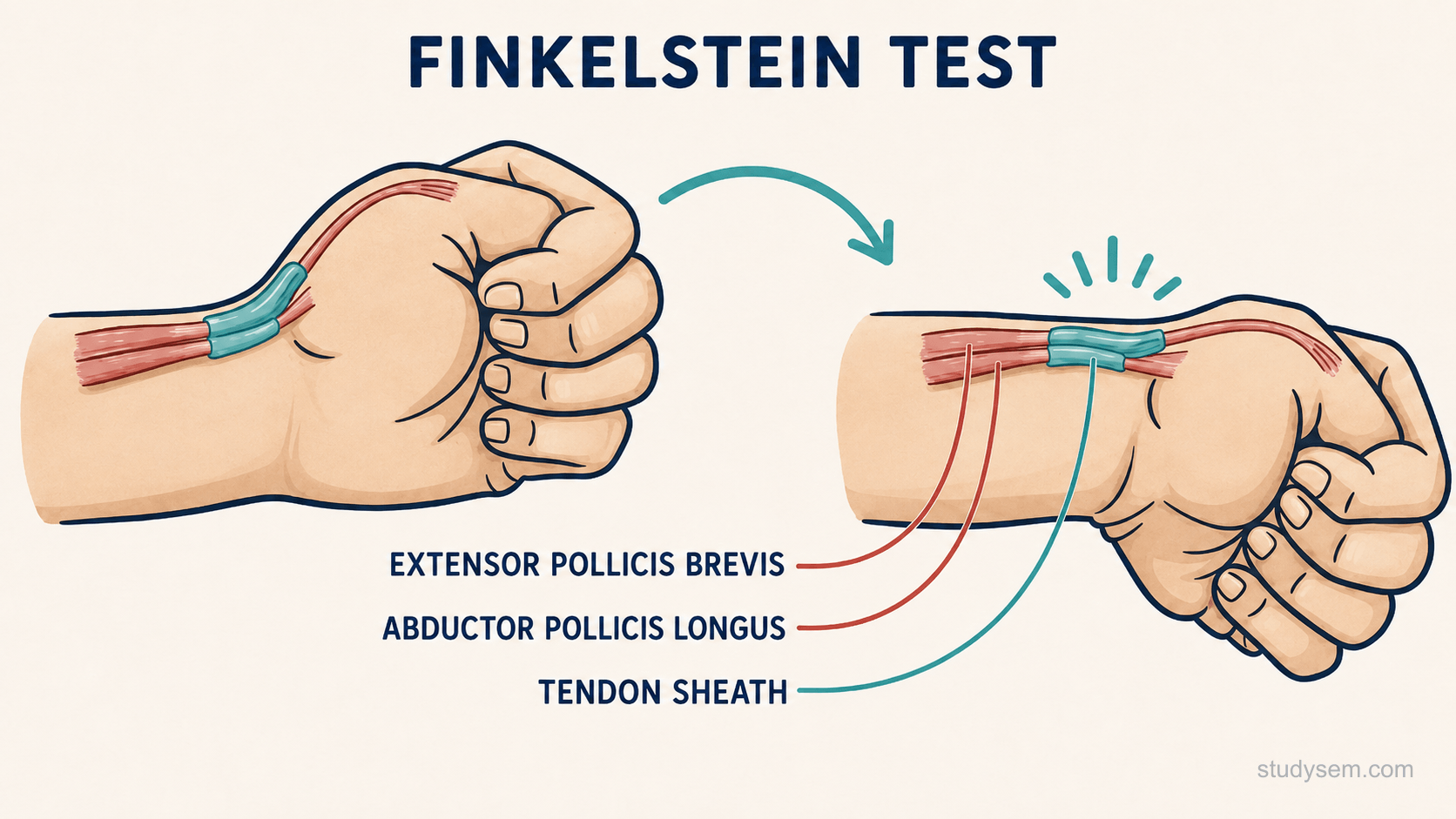 First dorsal compartment anatomy showing APL and EPB tendons and Finkelstein's test with thumb tucked into fist and ulnar deviation provoking radial-sided pain.