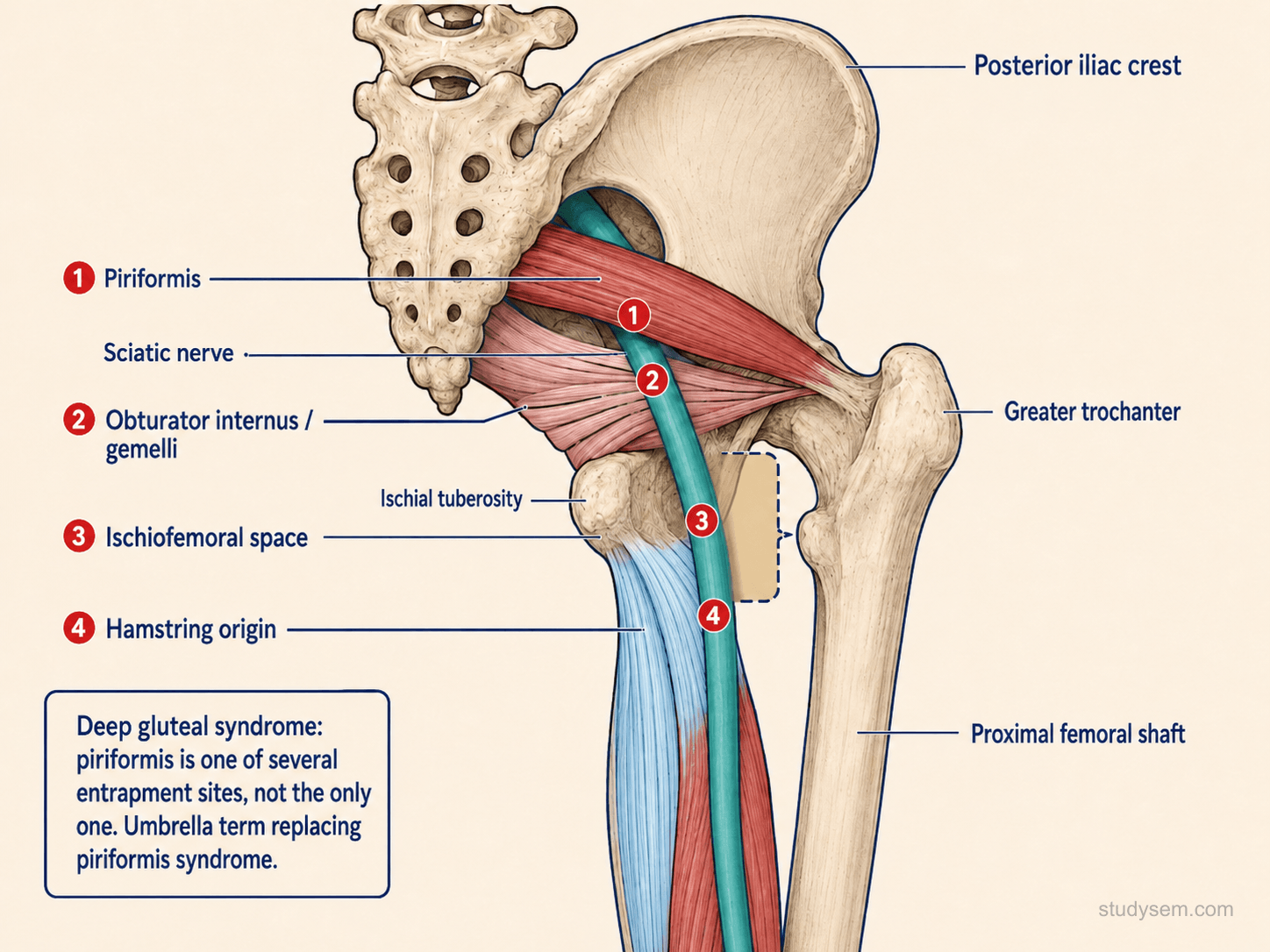 Posterior view of the deep gluteal space showing the sciatic nerve with four potential entrapment sites: piriformis, obturator internus and gemelli, ischiofemoral space, and hamstring origin