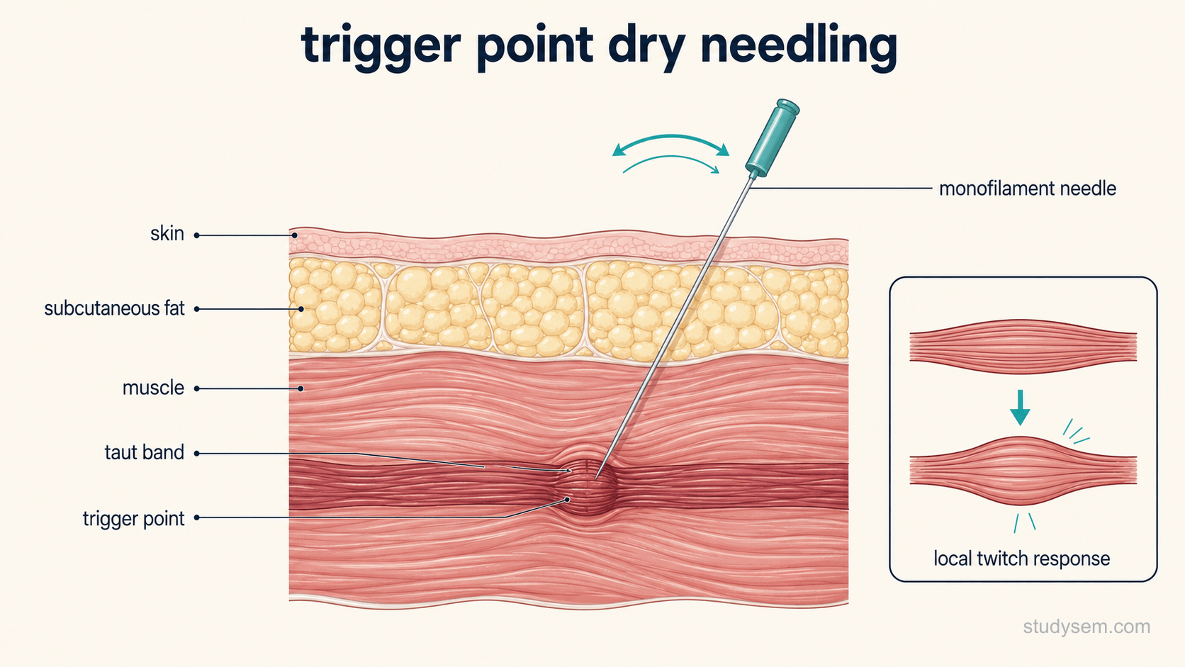 Anatomically accurate cross-section through skin, subcutaneous fat and skeletal muscle, showing a taut band within the muscle containing a trigger point nodule. A fine solid monofilament needle passes through the skin into the nodule, with a small motion arc indicating the needle being moved in and out. A simple inset shows the muscle briefly contracting to represent the local twitch response. Labels only: skin, subcutaneous fat, muscle, taut band, trigger point, monofilament needle, local twitch response.