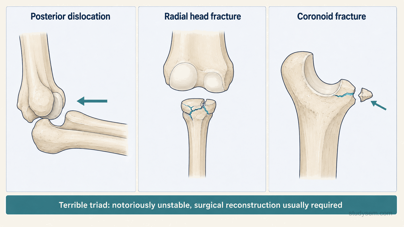 Terrible triad of the elbow showing posterior dislocation with radial head fracture and coronoid fracture.
