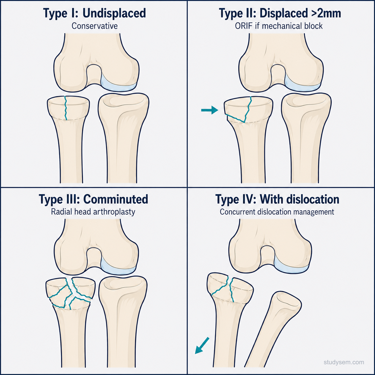 Mason classification of radial head fractures showing four types from undisplaced through comminuted to fracture with dislocation.