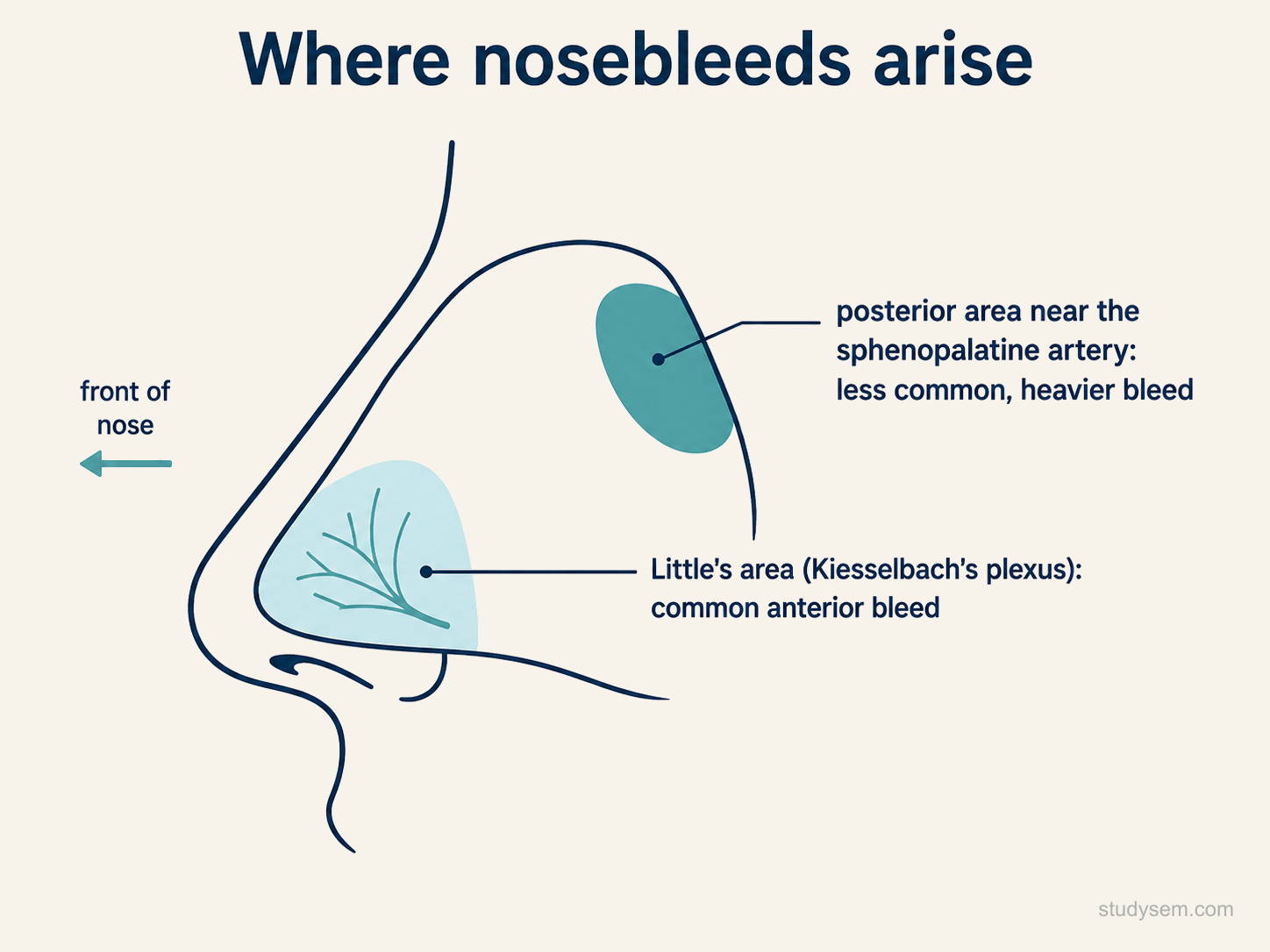 A side view of the nasal septum showing where nosebleeds arise: the common anterior site at Little's area, which contains Kiesselbach's plexus, and the less common posterior site near the sphenopalatine artery.