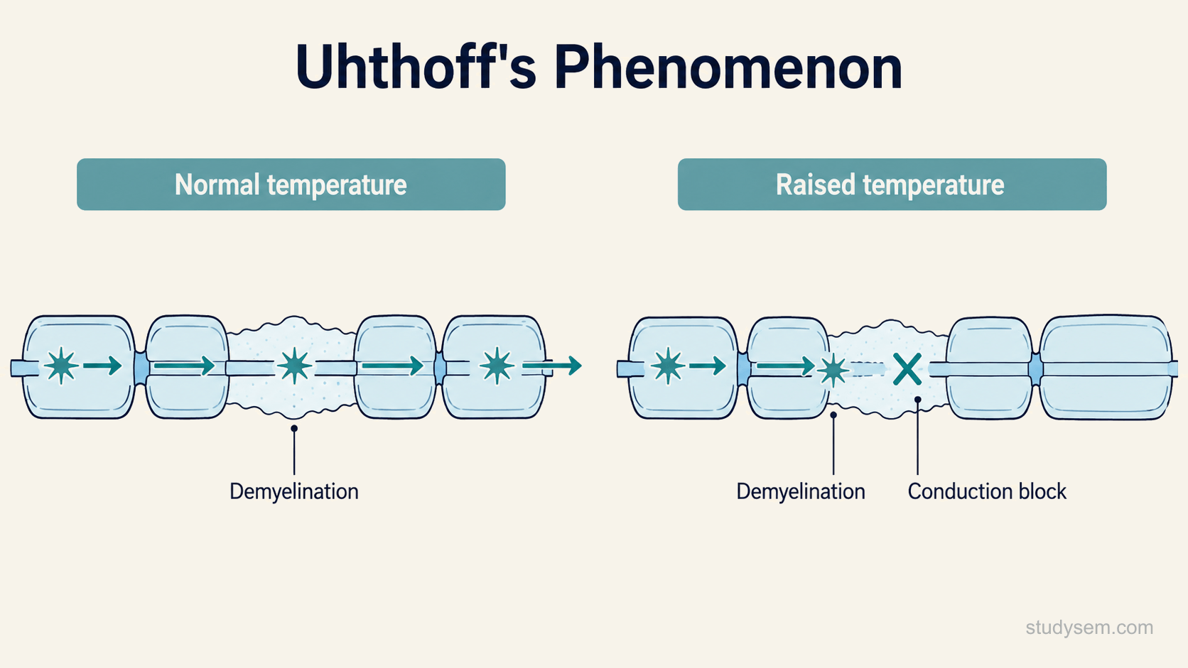 A diagram illustrating Uhthoff's phenomenon. On the left, a demyelinated nerve axon at normal body temperature showing an action potential conducting successfully along it. On the right, the same demyelinated axon at raised body temperature showing the action potential failing at the demyelinated segment, representing temperature-dependent conduction block. Short labels mark normal temperature, raised temperature, the demyelinated segment and conduction block.