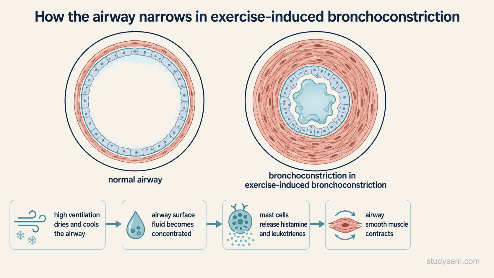 Two bordered ring cross-sections comparing a normal open small airway with a constricted airway in exercise-induced bronchoconstriction, above a four-step strip showing high ventilation drying and cooling the airway, airway surface fluid becoming concentrated, mast cells releasing histamine and leukotrienes, and airway smooth muscle contracting.