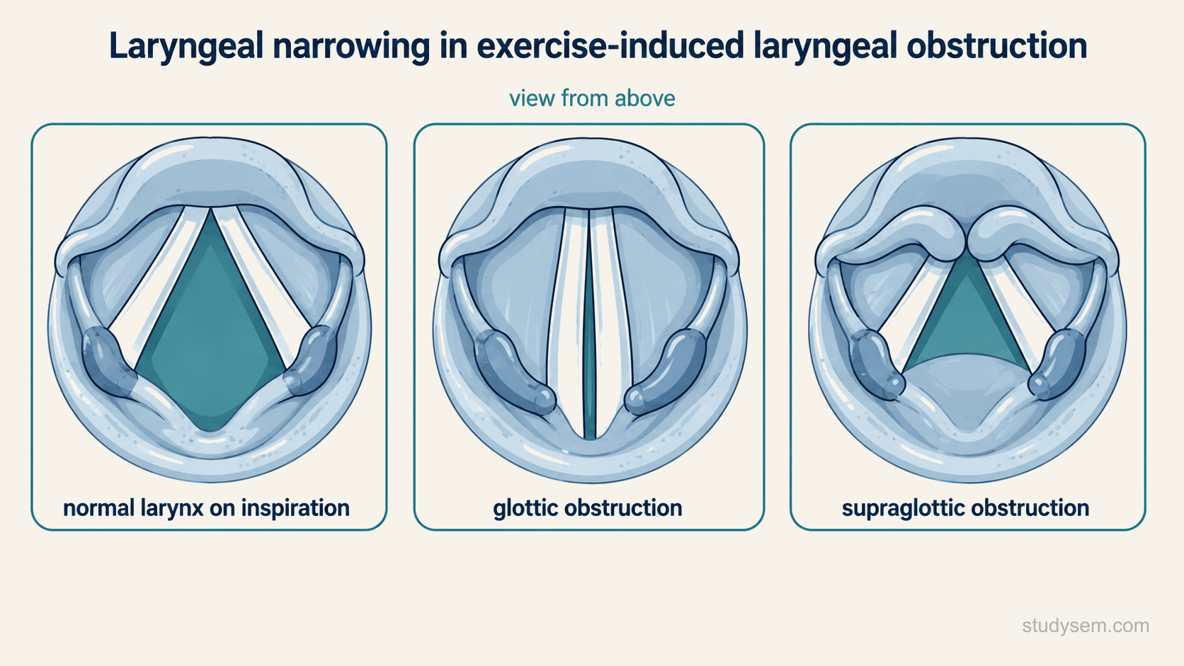 Three top-down laryngoscopic panels comparing a normal open larynx on inspiration with glottic obstruction, where the true vocal folds move together, and supraglottic obstruction, where the structures above the folds collapse inwards.