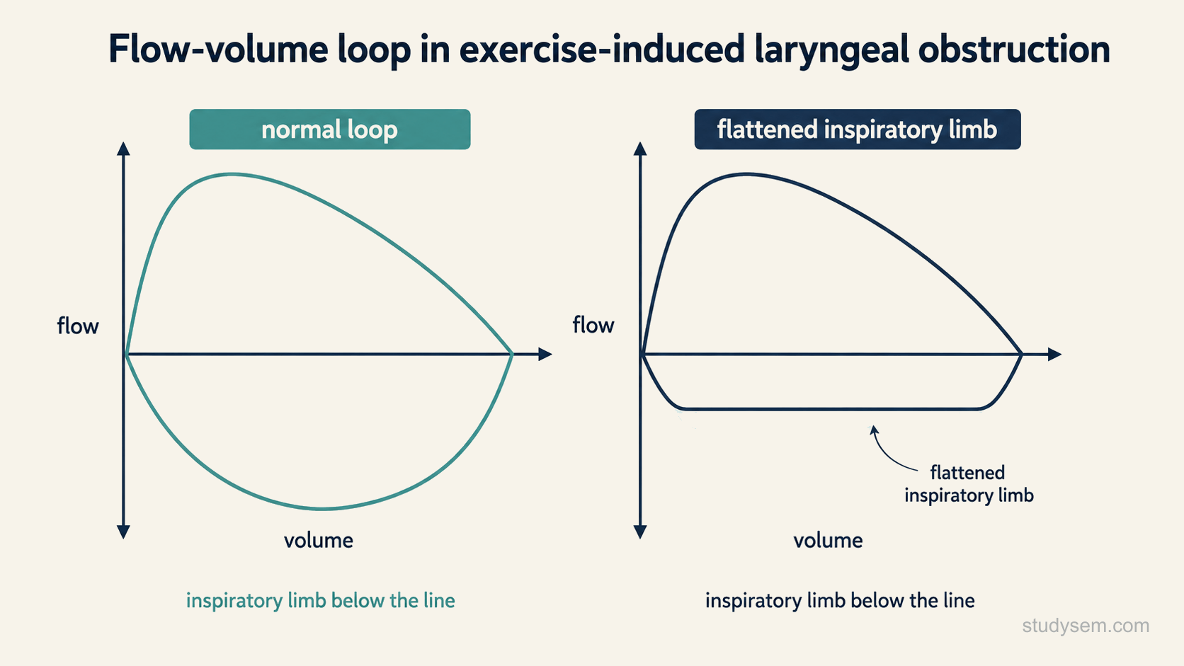 Two flow-volume loops compared, a normal loop beside one with a flattened inspiratory limb, illustrating the inspiratory flow limitation seen in exercise-induced laryngeal obstruction during symptoms.