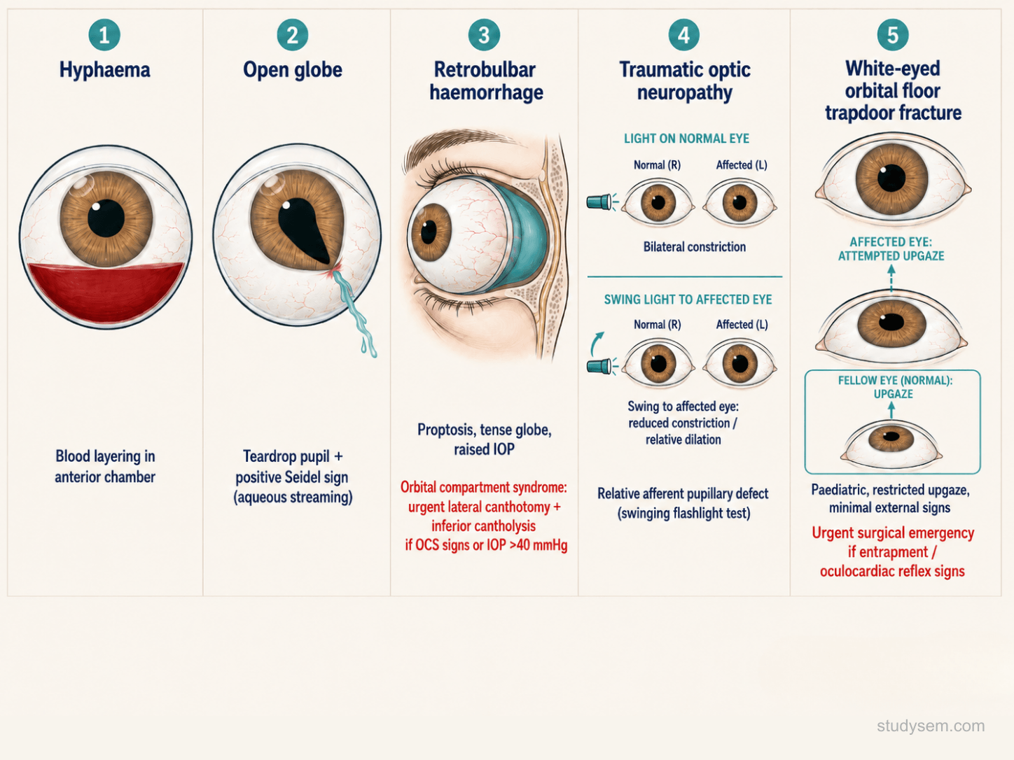 Panel diagram of the five sight-threatening sports eye injuries - open globe with peaked pupil, hyphaema with blood layering in the anterior chamber, retinal detachment, orbital fracture with inferior rectus entrapment (paediatric white-eyed trapdoor), and chemical injury with conjunctival injection