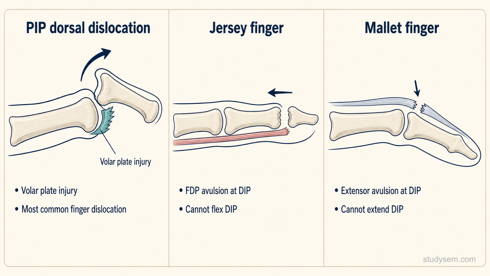 Three-panel lateral finger diagram comparing PIP dorsal dislocation with volar plate injury, jersey finger with FDP avulsion at the DIP, and mallet finger with terminal extensor avulsion at the DIP.