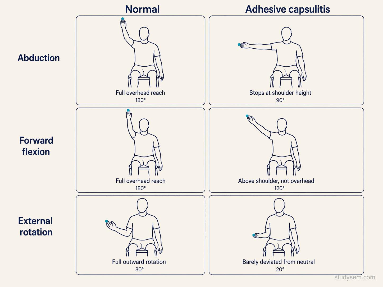 Six-panel comparative diagram showing the capsular pattern of restriction in adhesive capsulitis: external rotation disproportionately restricted, abduction moderately restricted, forward flexion least affected.