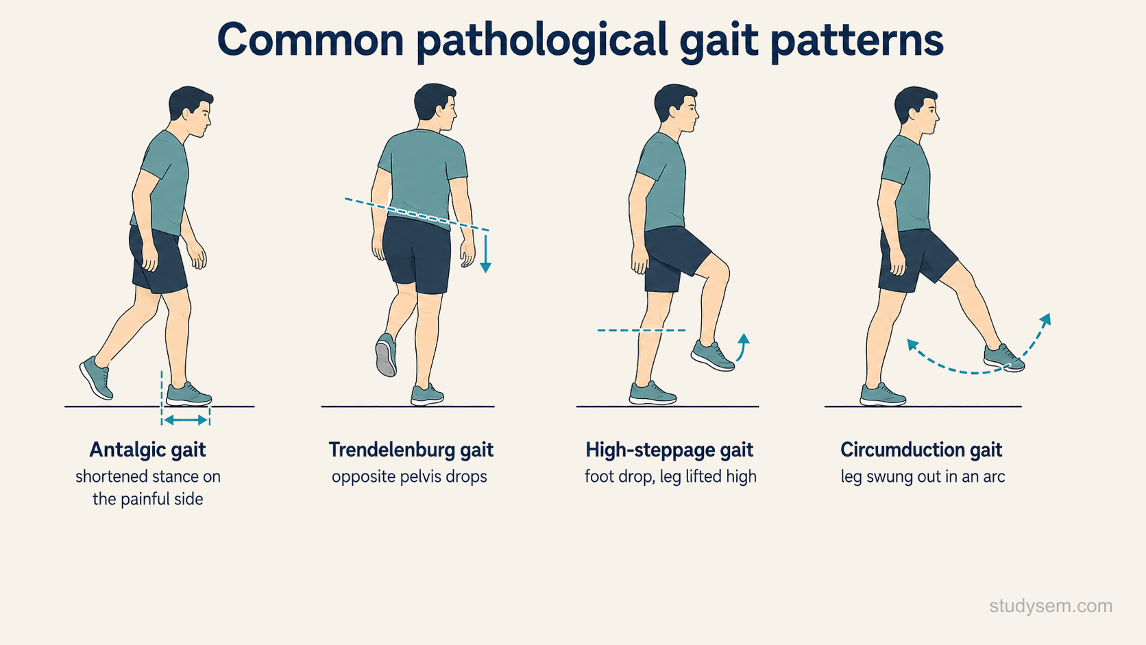 A concept figure comparing four common pathological gait patterns as stylised whole figures: an antalgic gait with a shortened, guarded stance on the painful side, a Trendelenburg gait with the pelvis dropping to the swing side during single-leg stance, a high-steppage gait with exaggerated hip and knee flexion to clear a dropped foot, and a circumduction gait with the leg swung outward in an arc.