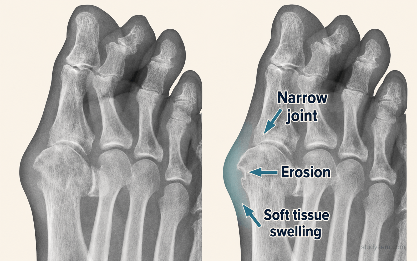 Plain radiograph of the first metatarsophalangeal joint in chronic tophaceous gout showing a periarticular punched-out erosion with sclerotic overhanging edges (Martel's sign) and preserved adjacent bone density