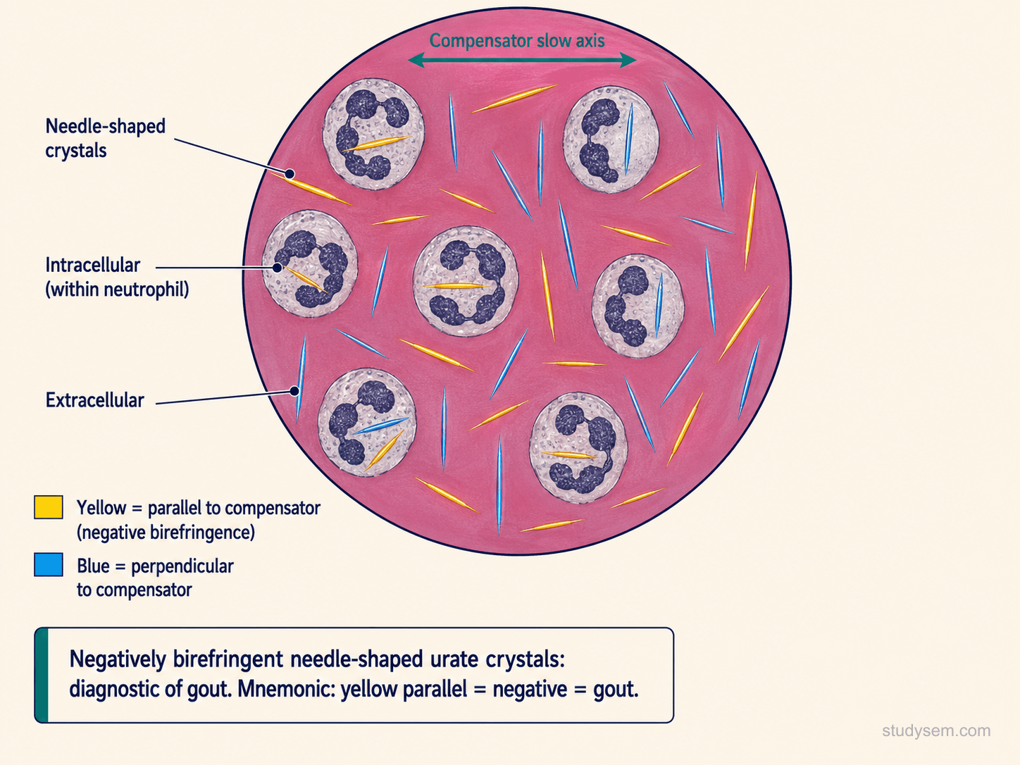 Compensated polarised light microscopy of synovial fluid showing needle-shaped monosodium urate crystals that appear yellow when aligned parallel to the slow-axis of the compensator and blue when perpendicular, demonstrating strong negative birefringence