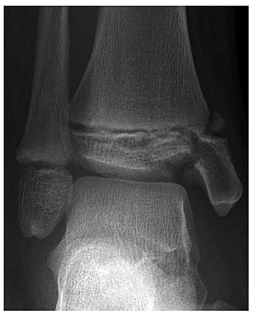 Anteroposterior ankle radiograph of a child showing a Salter-Harris type III fracture of the distal tibia, in which the fracture line passes through the physis and exits through the epiphysis into the joint; the distal tibial epiphysis, physis and metaphysis are visible.