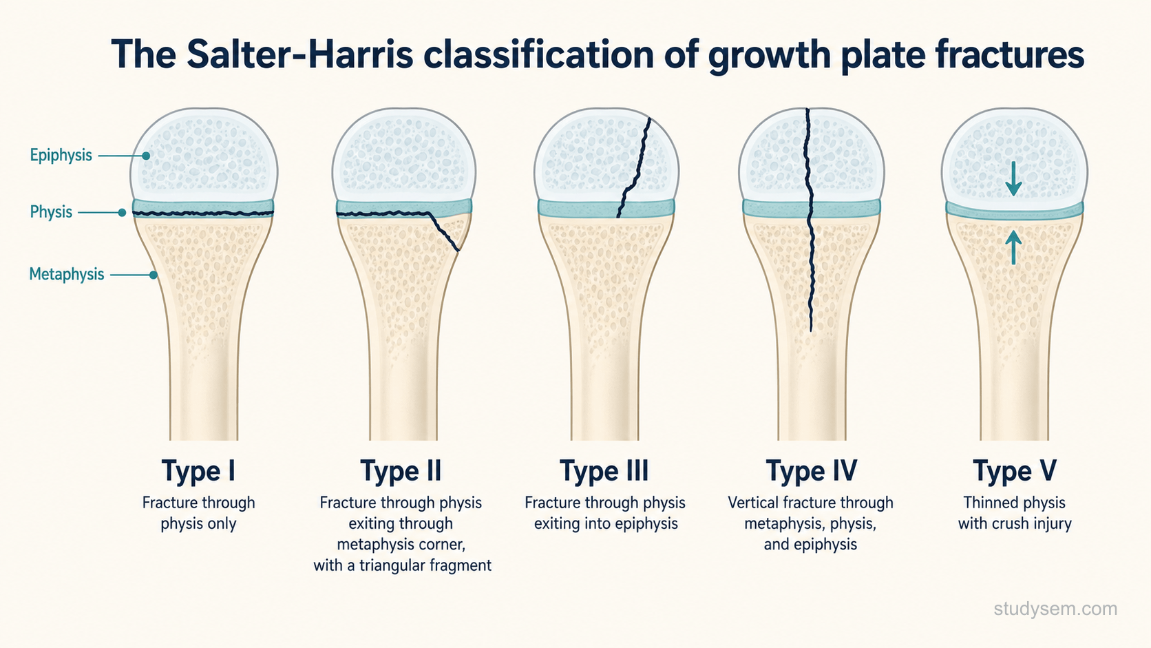 Diagram of the Salter-Harris classification of growth plate fractures, showing the epiphysis, physis and metaphysis of a long bone end and the five fracture patterns: type I through the physis only; type II through the physis exiting the metaphysis as a triangular fragment; type III through the physis exiting into the epiphysis; type IV a vertical fracture crossing metaphysis, physis and epiphysis; and type V a crush injury thinning the physis.