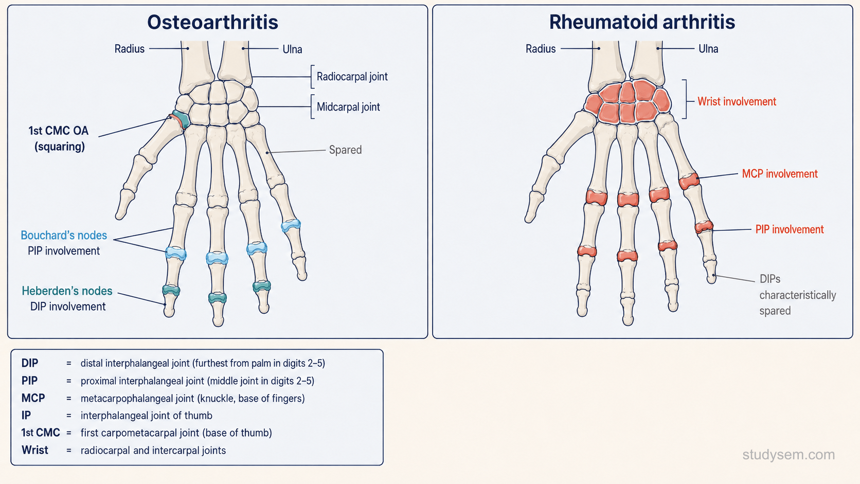 Comparative hand diagram showing OA joint distribution targeting DIPs, PIPs, and 1st CMC joint versus RA distribution targeting MCPs, PIPs, and wrist while sparing DIPs.