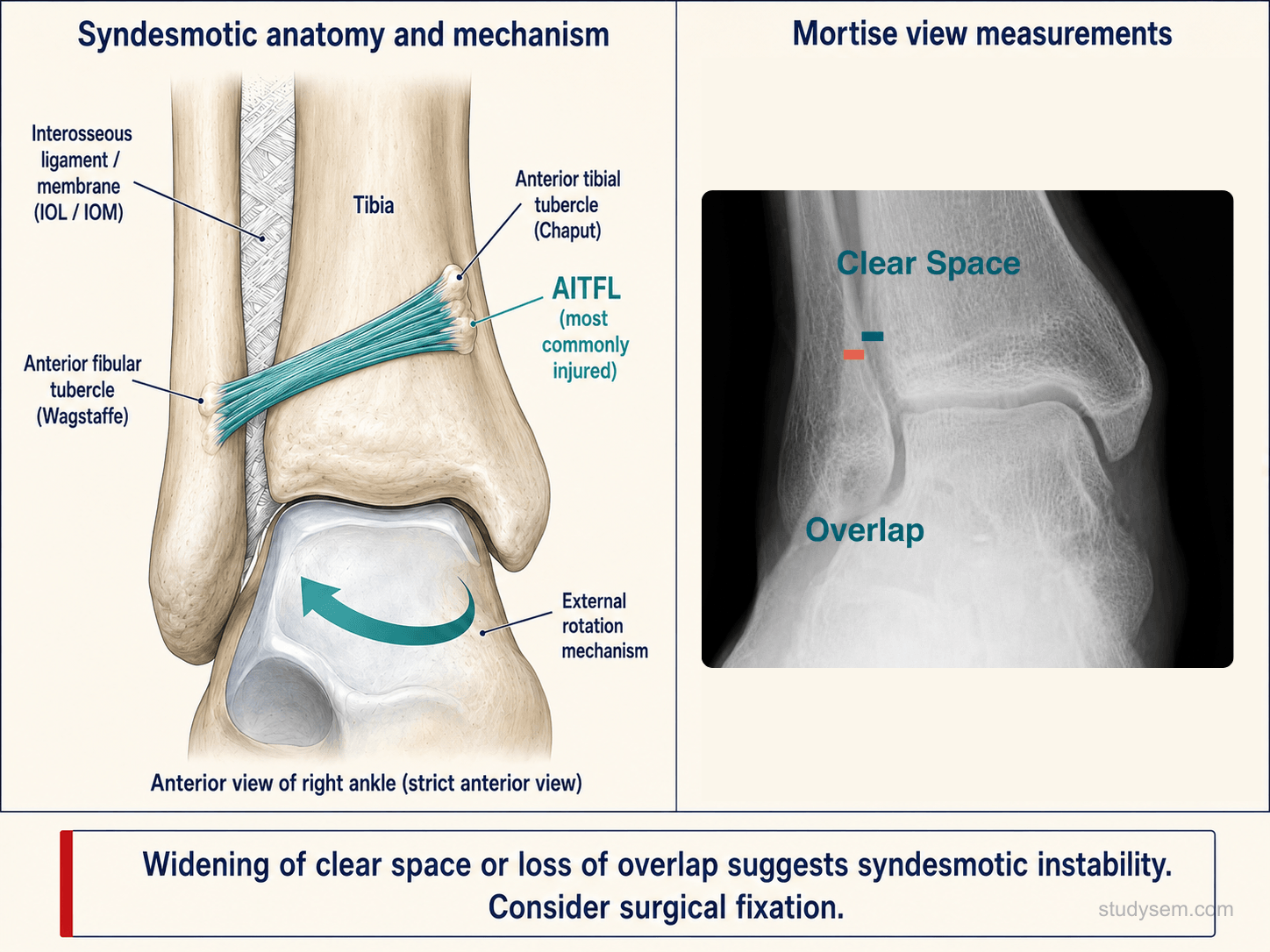 Distal tibiofibular syndesmosis anatomy paired with a mortise-view radiograph showing the measurement landmarks for tibiofibular clear space, tibiofibular overlap, and medial clear space