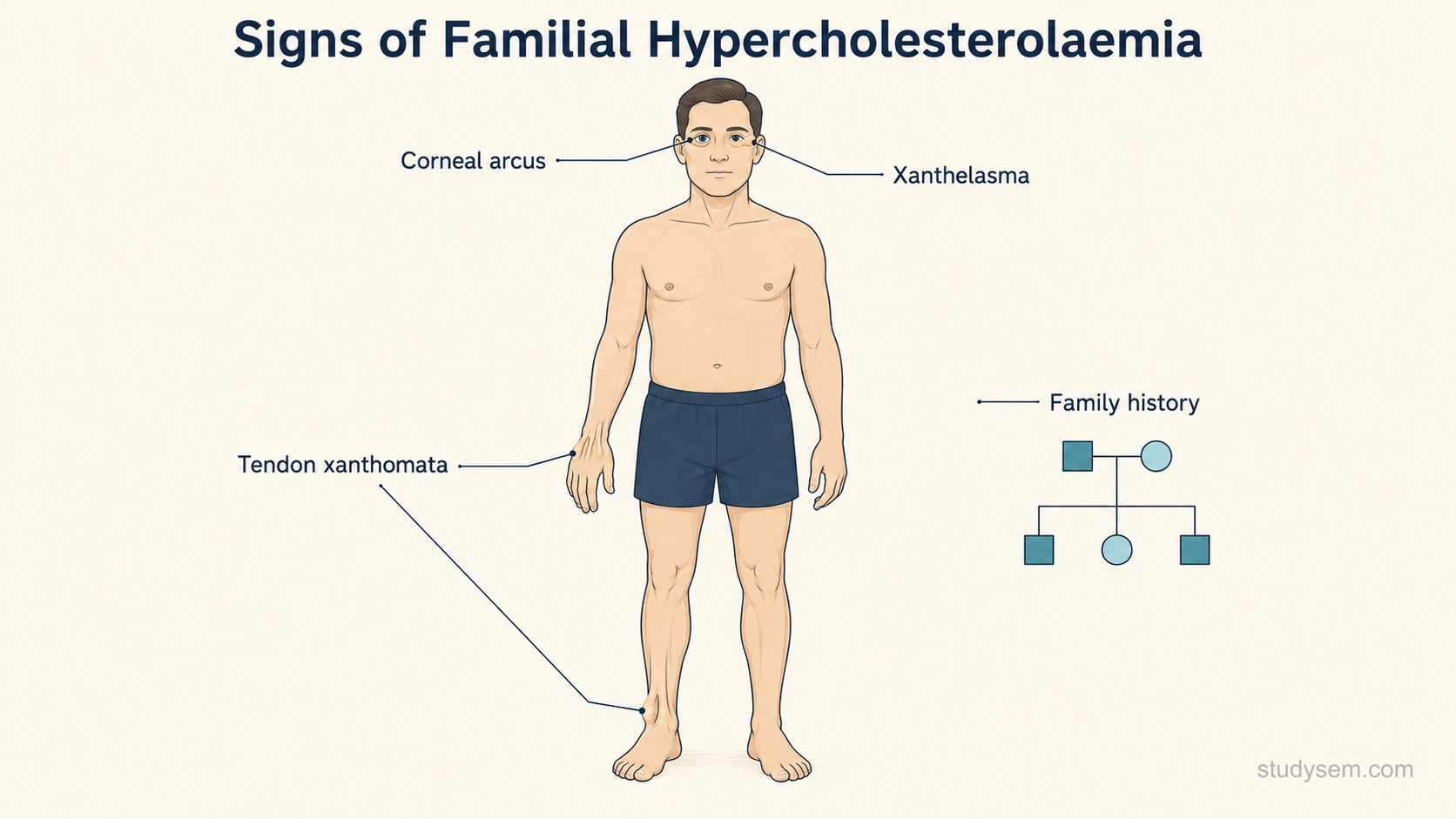 A clinical recognition diagram for familial hypercholesterolaemia laid out as a central figure with four short labelled pointers to physical signs and history features: tendon xanthomata shown as thickening at the Achilles tendon and the extensor tendons of the hand, corneal arcus shown as a pale ring at the edge of the iris in a young person, xanthelasma shown as pale plaques at the medial eyelid, and a small family tree symbol indicating premature cardiovascular disease in relatives.