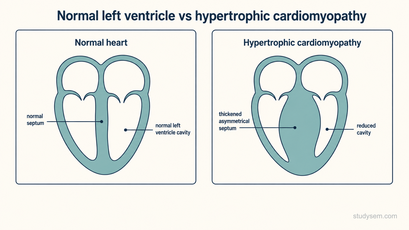 Schematic comparing a normal left ventricle with hypertrophic cardiomyopathy: the normal heart has a normal-thickness septum and a normal left ventricular cavity, while the HCM heart shows a markedly and asymmetrically thickened interventricular septum and a reduced left ventricular cavity.