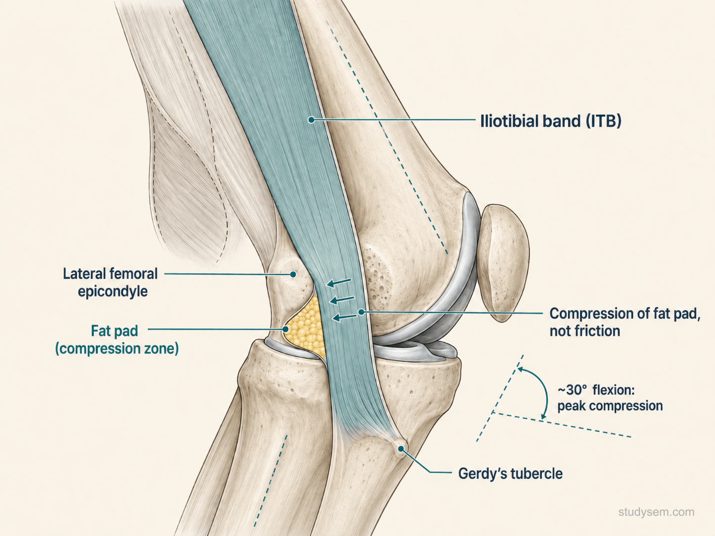 Lateral view of knee showing iliotibial band compressing against the lateral femoral epicondyle at 30 degrees flexion with underlying fat pad