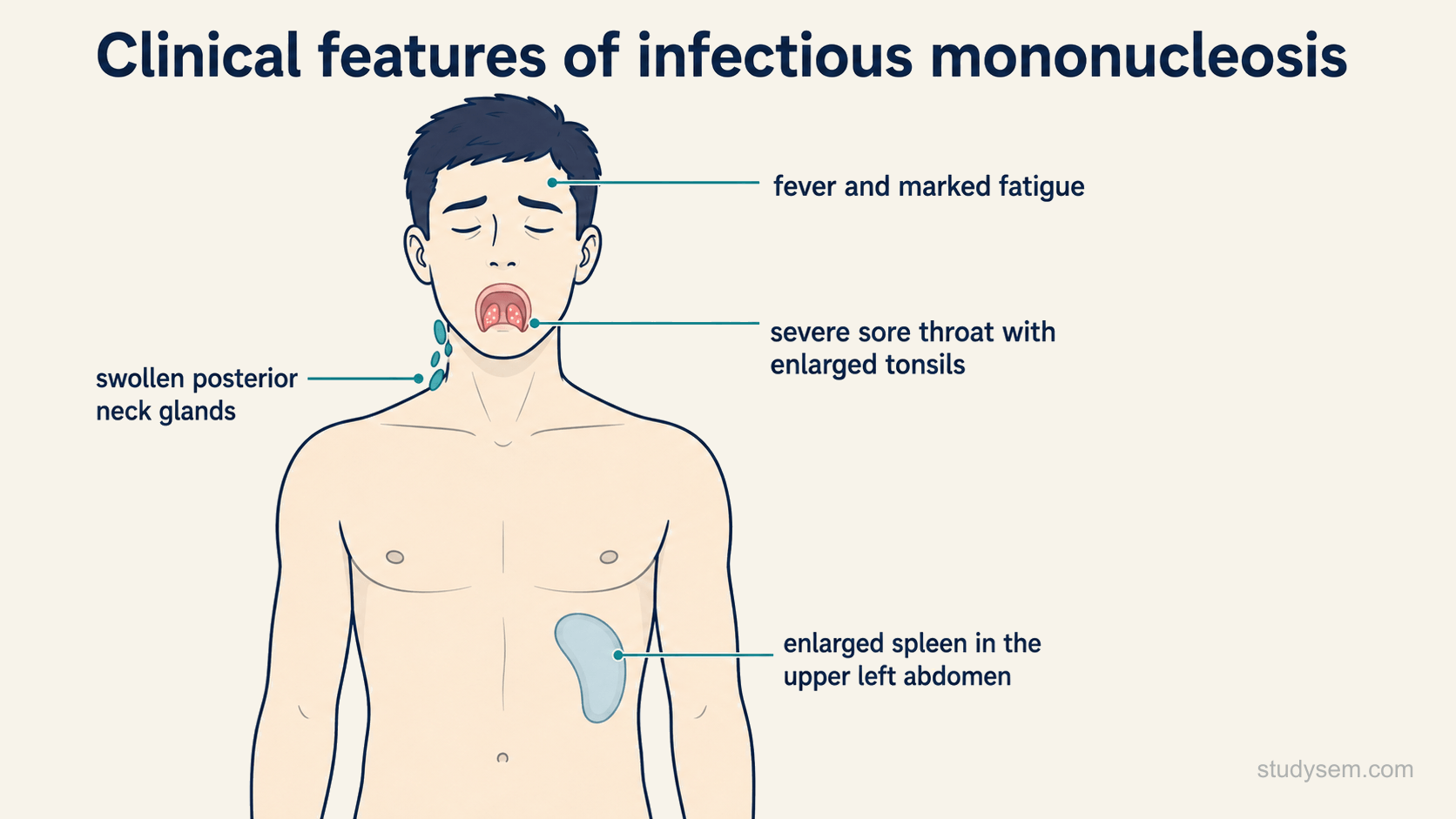 A labelled front-view figure of the classic clinical features of infectious mononucleosis, showing fever and marked fatigue, a severe sore throat with enlarged tonsils, swollen posterior neck glands, and an enlarged spleen in the upper left abdomen.