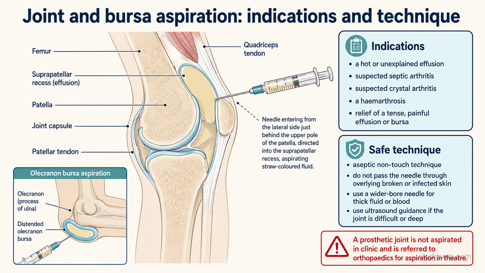 An educational figure titled 'Joint and bursa aspiration: indications and technique'. An anatomically accurate knee in cross-section shows a large effusion distending the suprapatellar recess above the patella, with a needle entering from the side just behind the upper pole of the patella to withdraw fluid, and the femur, patella, quadriceps tendon, joint capsule and effusion labelled. A second small inset shows an olecranon bursa at the point of the elbow being aspirated. A bordered 'indications' panel lists: a hot or unexplained effusion, suspected septic arthritis, suspected crystal arthritis, and a haemarthrosis, plus relief of a tense, painful effusion or bursa. A bordered 'safe technique' panel lists: aseptic non-touch technique, do not pass the needle through overlying broken or infected skin, use a wider-bore needle for thick fluid or blood, and use ultrasound guidance if the joint is difficult or deep. A prominent warning reads: a prosthetic joint is not aspirated in the general clinic and is referred urgently to orthopaedics for aspiration in an appropriate sterile environment.