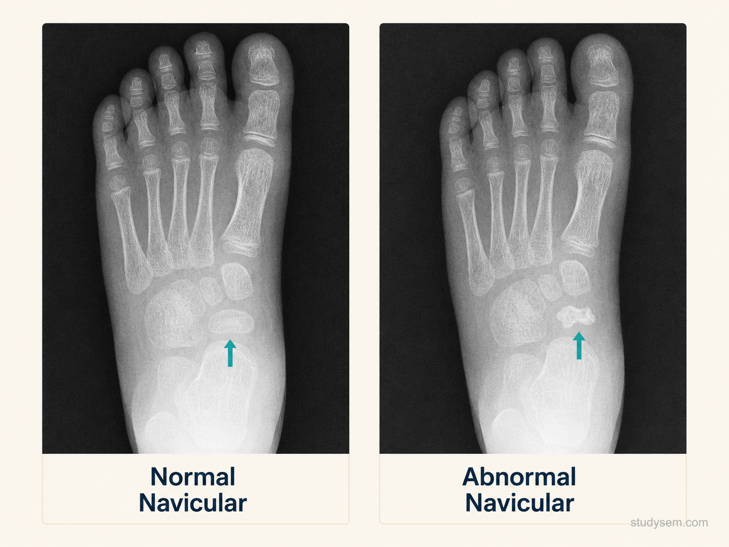 Two anteroposterior foot radiographs of a child side by side. The normal navicular (left, arrowed) shows a normal rounded ossific nucleus; the abnormal Köhler navicular (right, arrowed) is sclerotic, flattened into a thin disc and fragmented, with the adjacent joint spaces preserved.