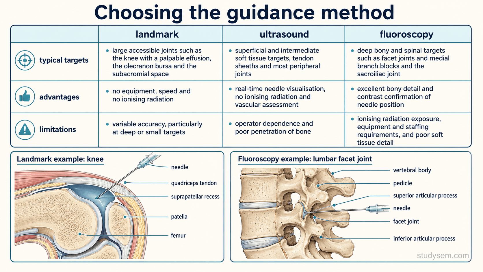 An educational figure titled 'Choosing the guidance method'. A central bordered comparison table with three columns headed 'landmark', 'ultrasound' and 'fluoroscopy', with rows for typical targets, advantages and limitations. The landmark column lists large accessible joints such as the knee with a palpable effusion, the olecranon bursa and the subacromial space; advantages of no equipment, speed and no ionising radiation; and limitations of variable accuracy, particularly at deep or small targets. The ultrasound column lists superficial and intermediate soft tissue targets, tendon sheaths and most peripheral joints; advantages of real-time needle visualisation, no ionising radiation and vascular assessment; and limitations of operator dependence and poor penetration of bone. The fluoroscopy column lists deep bony and spinal targets such as facet joints and medial branch blocks and the sacroiliac joint; advantages of excellent bony detail and contrast confirmation of needle position; and limitations of ionising radiation exposure, equipment and staffing requirements, and poor soft tissue detail. Anatomically accurate small insets show a knee joint in cross-section with a needle entering the suprapatellar recess by landmarks, and a lumbar spine in oblique view showing the facet joint with a needle at the target under fluoroscopic guidance, with correct vertebral body, pedicle, superior and inferior articular processes labelled.