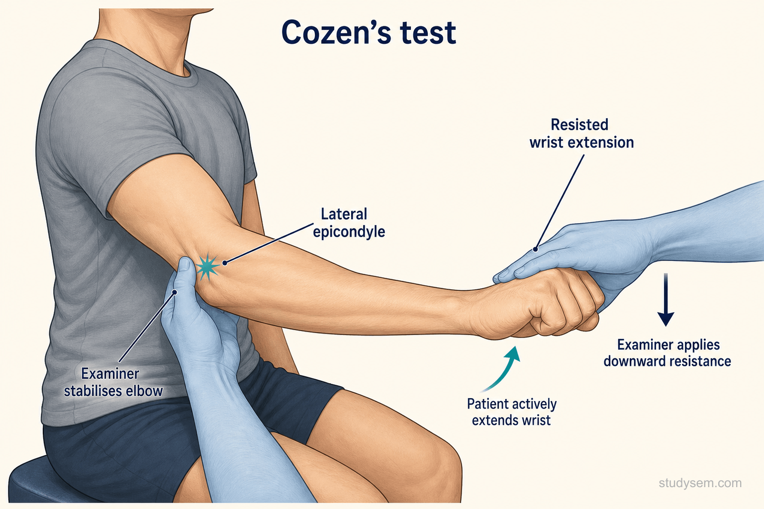 Cozen's test for lateral epicondylalgia showing resisted wrist extension with elbow extended and pain localised to the lateral epicondyle.