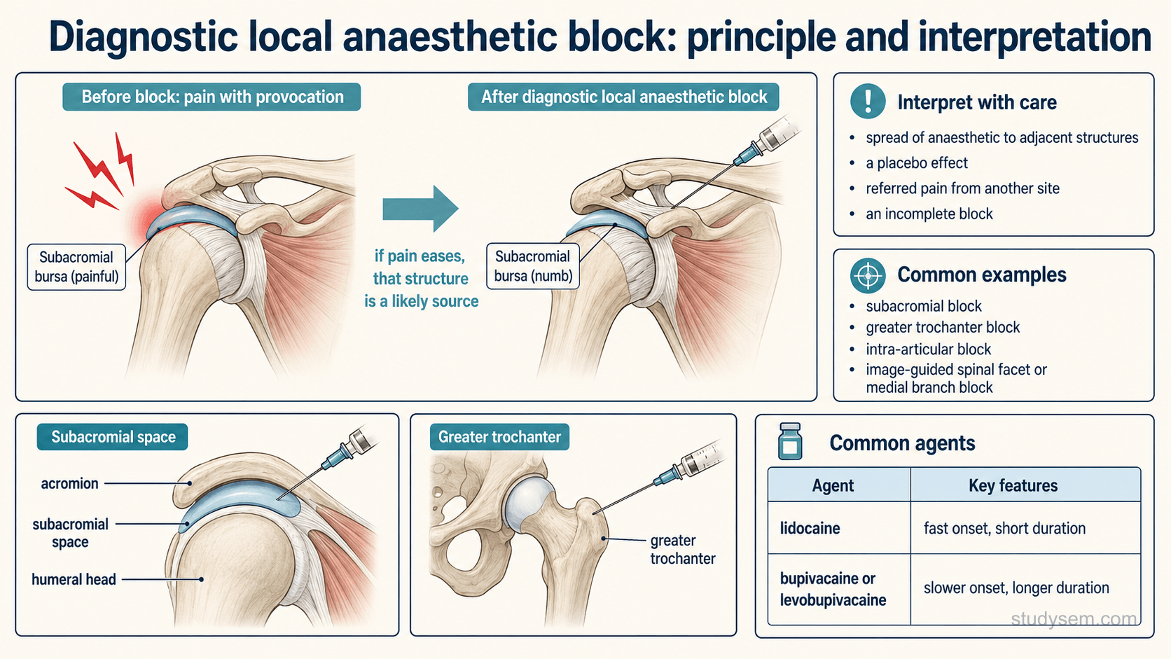 An educational figure titled 'Diagnostic local anaesthetic block: principle and interpretation'. A simple before-and-after shows a painful structure, then the same structure after a targeted local anaesthetic injection with the pain reduced, illustrating that meaningful pain relief supports that structure as the source. A bordered 'interpret with care' panel lists confounders: spread of anaesthetic to adjacent structures, a placebo effect, referred pain, and an incomplete block. A second panel lists common examples: a subacromial block at the shoulder, a greater trochanter block at the hip, an intra-articular block, and image-guided spinal facet or medial branch blocks. A small table contrasts two agents: lidocaine with fast onset and short duration, and bupivacaine or levobupivacaine with slower onset and longer duration. Anatomically accurate small insets show the subacromial space beneath the acromion and the greater trochanter of the femur with correct bony contours.