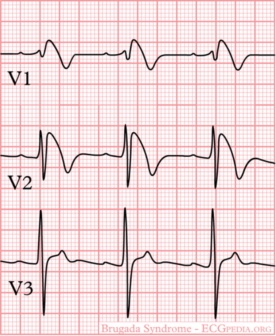 Electrocardiogram of the type 1 Brugada pattern, showing coved ST-segment elevation with T-wave inversion in the right precordial leads V1 to V3.