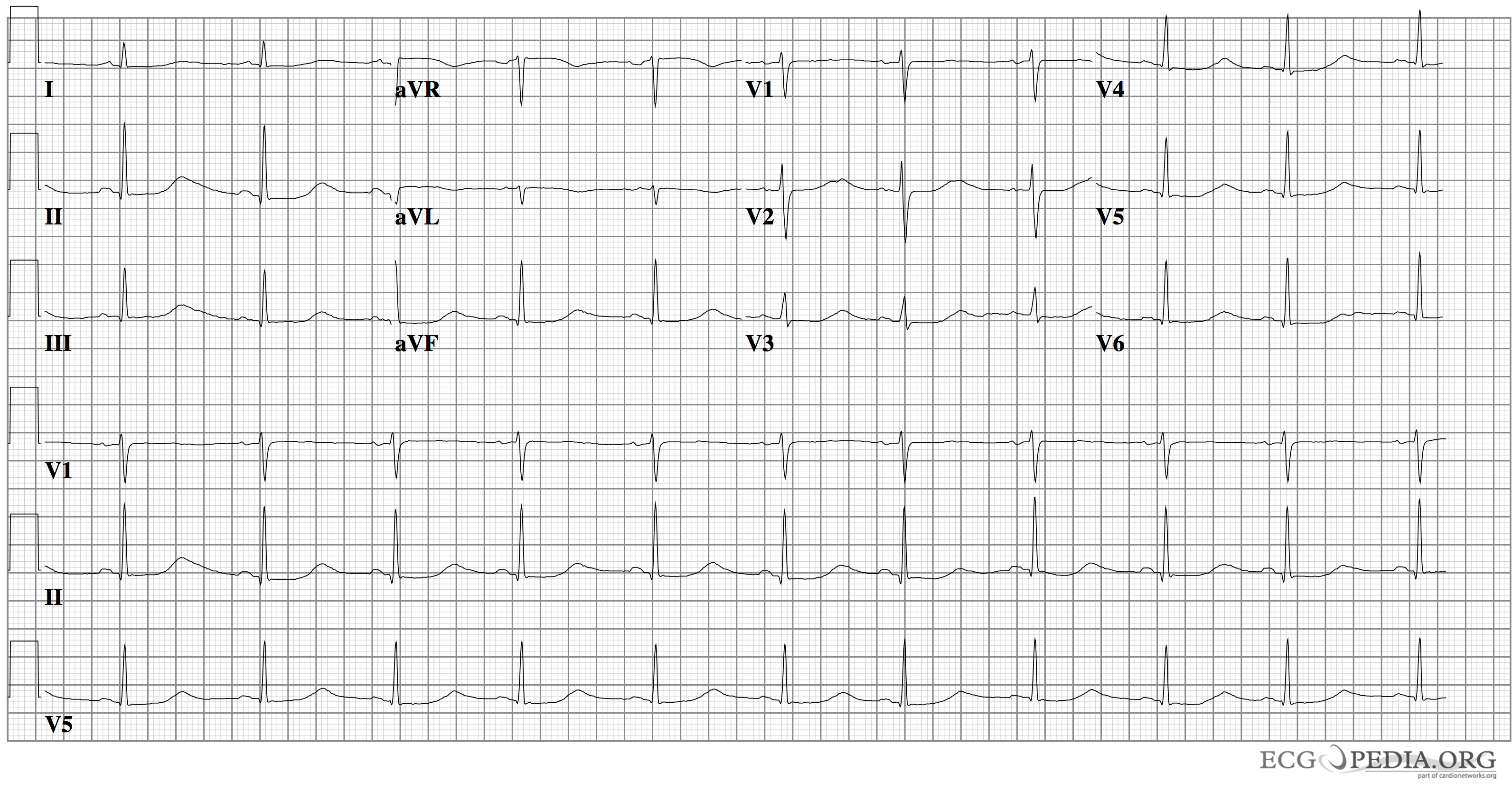 Twelve-lead electrocardiogram of long QT syndrome, showing a prolonged QT interval, where the recovery phase of each heartbeat is lengthened.