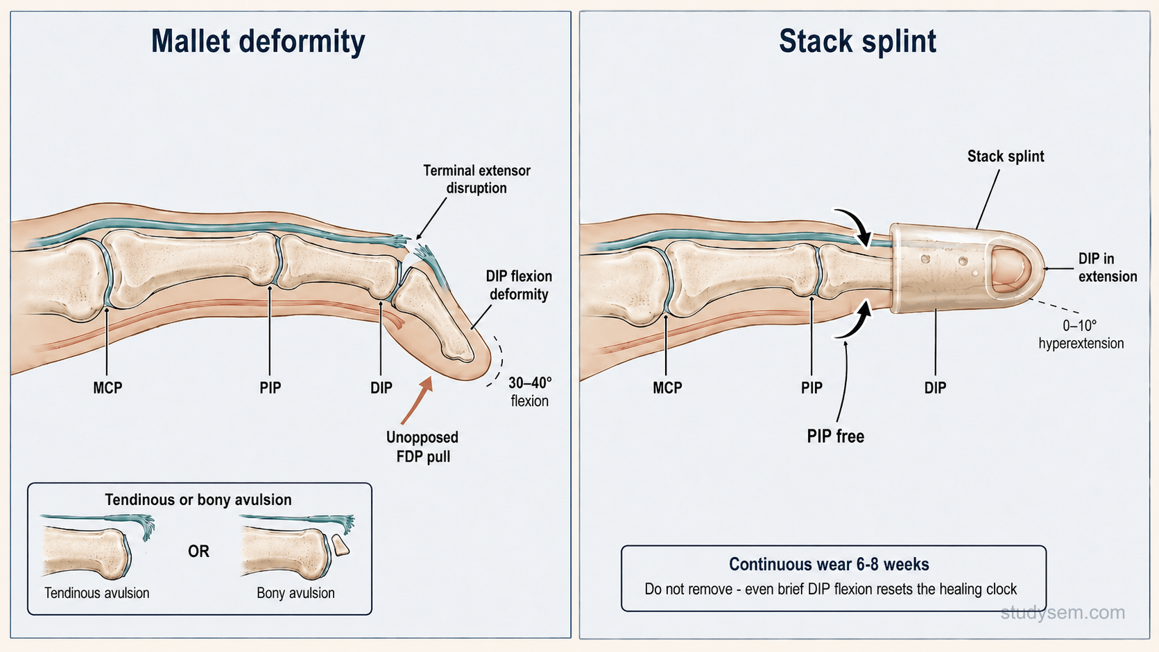 Two-panel diagram showing mallet finger DIP flexion deformity from terminal extensor disruption and stack splint holding the DIP in extension with PIP free.