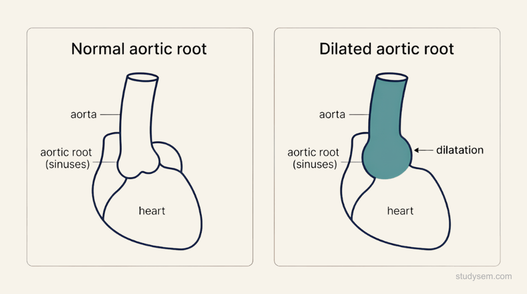 Schematic comparing a normal aortic root with a dilated aortic root in Marfan syndrome, showing the widening at the sinuses just above the heart.