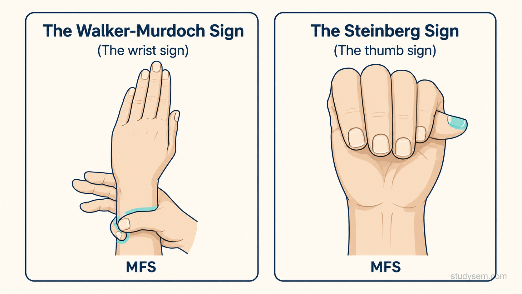 Two-panel diagram showing the wrist sign (Walker-Murdoch) and the thumb sign (Steinberg) in Marfan syndrome, bedside clues to long, slender digits.